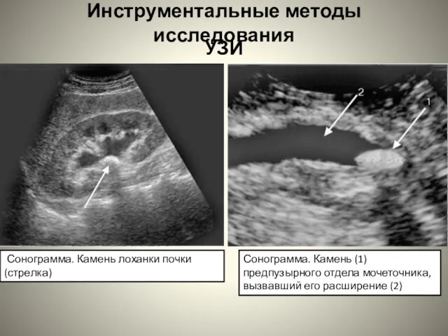 Инструментальные методы исследования УЗИ Сонограмма. Камень лоханки почки (стрелка) Сонограмма. Камень (1)