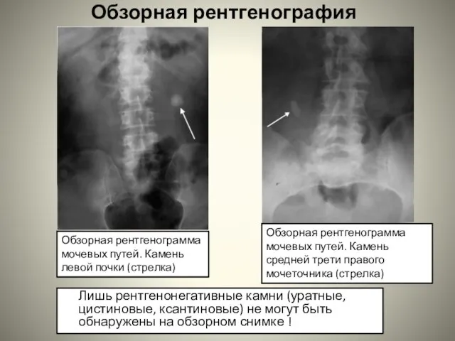 Обзорная рентгенография Лишь рентгенонегативные камни (уратные, цистиновые, ксантиновые) не могут быть обнаружены