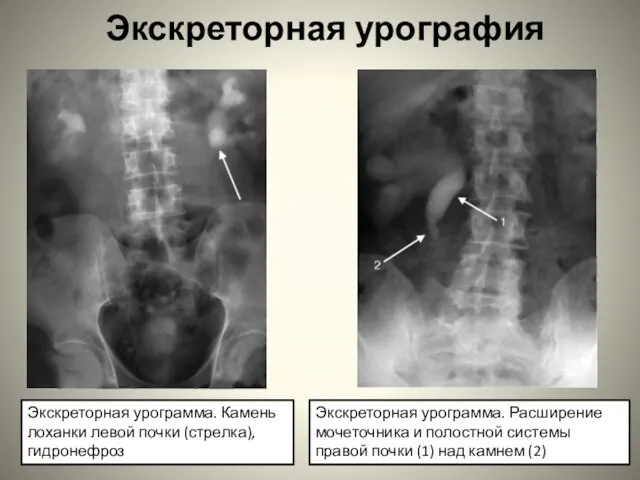 Экскреторная урография Экскреторная урограмма. Камень лоханки левой почки (стрелка), гидронефроз Экскреторная урограмма.