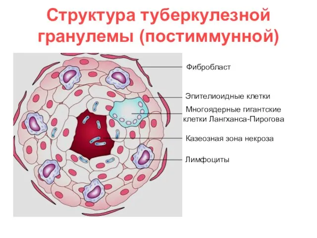Структура туберкулезной гранулемы (постиммунной) Фибробласт Многоядерные гигантские клетки Лангханса-Пирогова Эпителиоидные клетки Лимфоциты Казеозная зона некроза