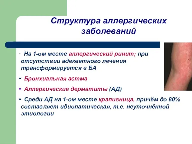 Структура аллергических заболеваний На 1-ом месте аллергический ринит; при отсутствии адекватного лечения