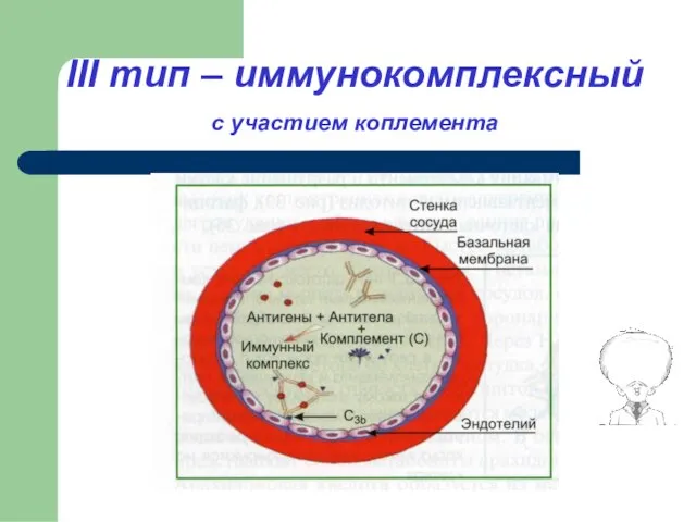 III тип – иммунокомплексный с участием коплемента