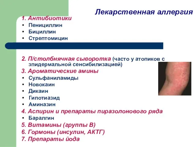 Лекарственная аллергия 1. Антибиотики Пенициллин Бициллин Стрептомицин 2. П/столбнячная сыворотка (часто у