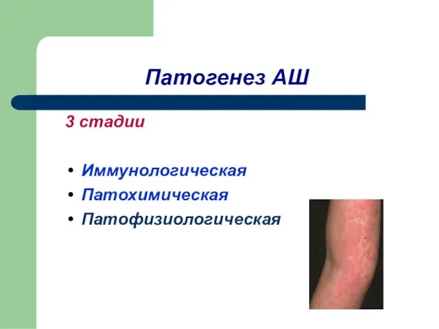 Патогенез АШ 3 стадии Иммунологическая Патохимическая Патофизиологическая