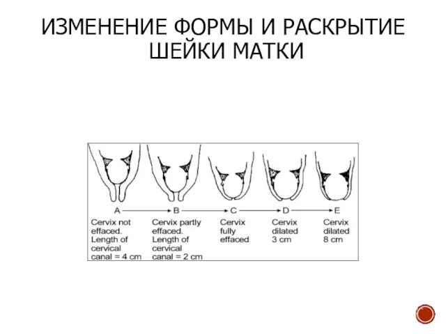 ИЗМЕНЕНИЕ ФОРМЫ И РАСКРЫТИЕ ШЕЙКИ МАТКИ