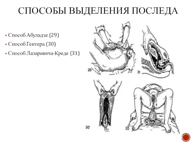 СПОСОБЫ ВЫДЕЛЕНИЯ ПОСЛЕДА Способ Абуладзе (29) Способ Гентера (30) Способ Лазаревича-Креде (31)