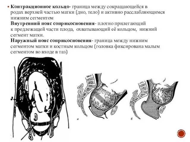 Контракционное кольцо- граница между сокращающейся в родах верхней частью матки (дно, тело)