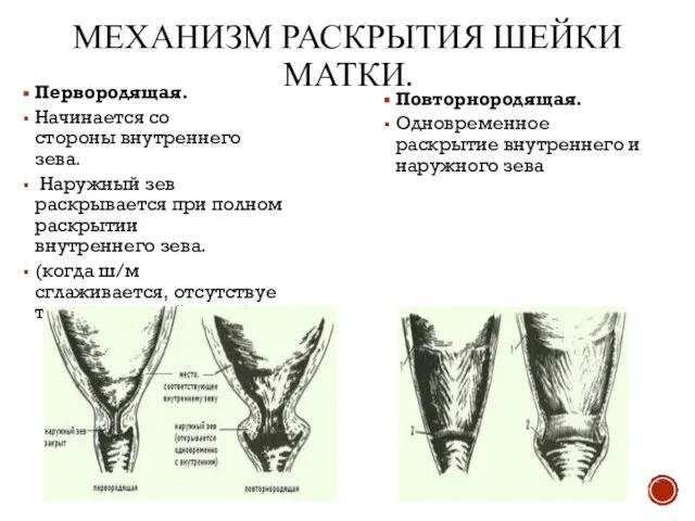 МЕХАНИЗМ РАСКРЫТИЯ ШЕЙКИ МАТКИ. Первородящая. Начинается со стороны внутреннего зева. Наружный зев