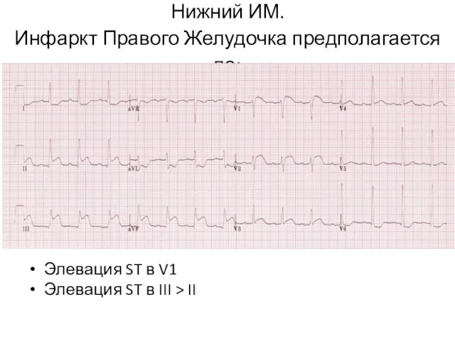 Нижний ИМ. Инфаркт Правого Желудочка предполагается по: Элевация ST в V1 Элевация