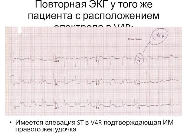 Повторная ЭКГ у того же пациента с расположением электрода в V4R: Имеется