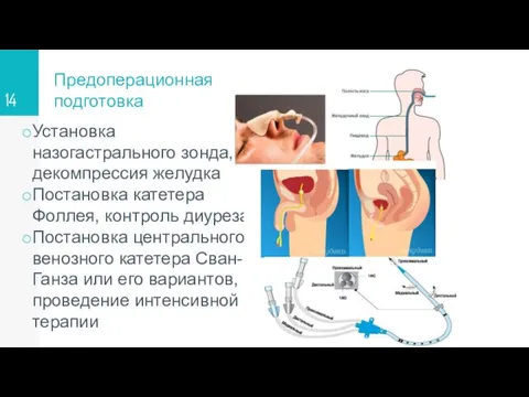 Предоперационная подготовка Установка назогастрального зонда, декомпрессия желудка Постановка катетера Фоллея, контроль диуреза