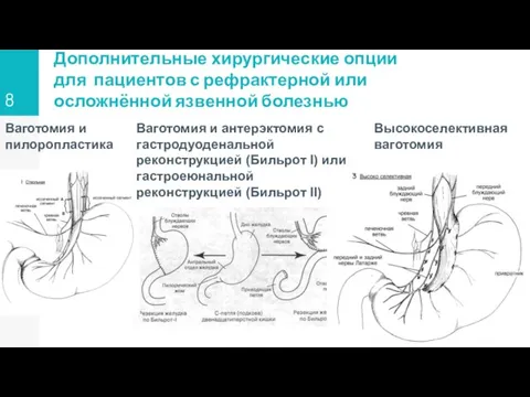 Дополнительные хирургические опции для пациентов с рефрактерной или осложнённой язвенной болезнью Ваготомия