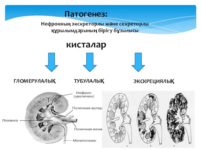 Патогенез: ГЛОМЕРУЛАЛЫҚ ТУБУЛАЛЫҚ ЭКСКРЕЦИЯЛЫҚ кисталар Нефронның экскреторлы және секреторлы құрылымдарының бірігу бұзылысы