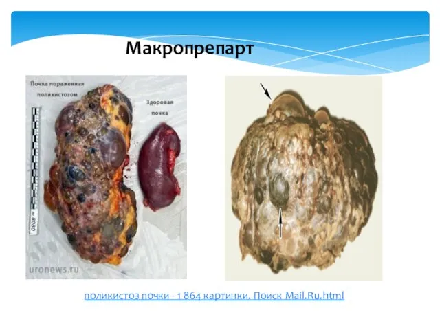 Макропрепарт поликистоз почки - 1 864 картинки. Поиск Mail.Ru.html