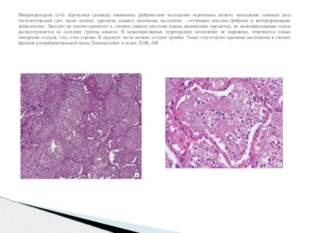 Микропрепараты (а-б). Крупозная (долевая) пневмония: фибринозное воспаление паренхимы легкого: воспаление занимает весь