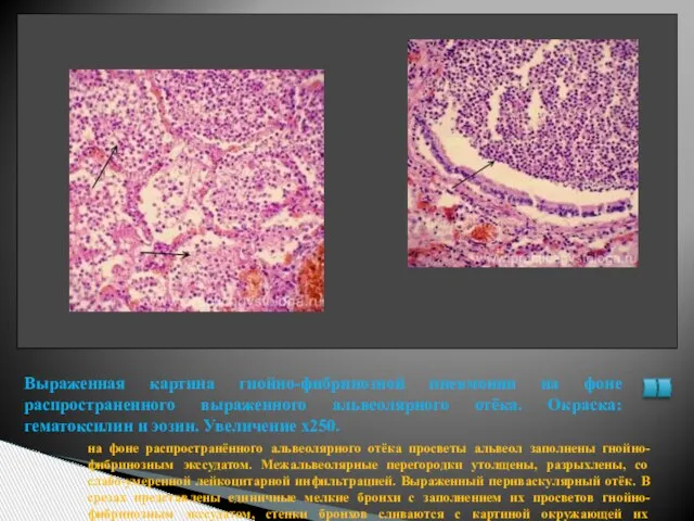 на фоне распространённого альвеолярного отёка просветы альвеол заполнены гнойно-фибринозным экссудатом. Межальвеолярные перегородки