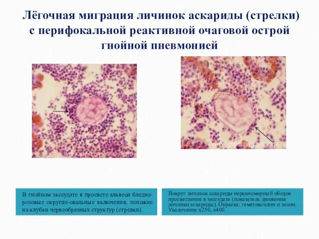 Лёгочная миграция личинок аскариды (стрелки) с перифокальной реактивной очаговой острой гнойной пневмонией