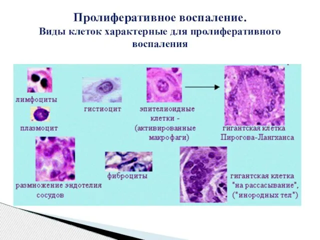 Пролиферативное воспаление. Виды клеток характерные для пролиферативного воспаления