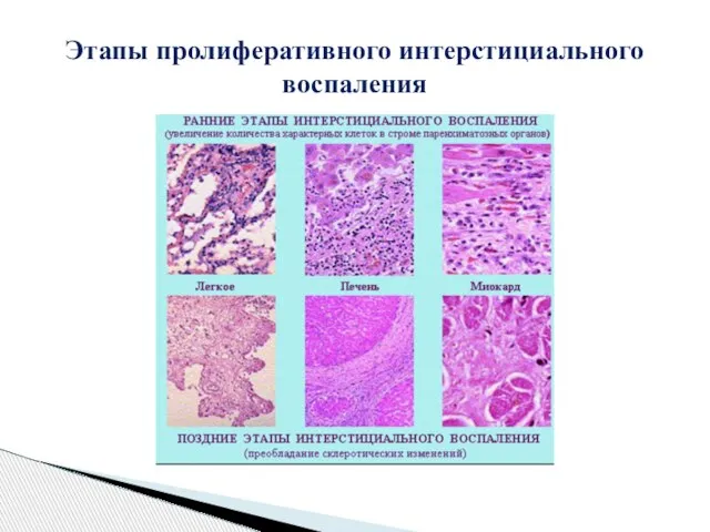 Этапы пролиферативного интерстициального воспаления