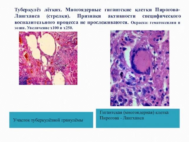 Туберкулёз лёгких. Многоядерные гигантские клетки Пирогова-Лангханса (стрелки). Признаки активности специфического воспалительного процесса