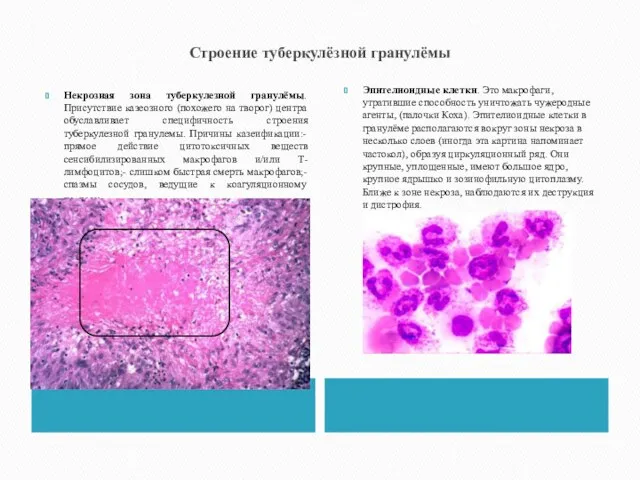 Строение туберкулёзной гранулёмы Некрозная зона туберкулезной гранулёмы. Присутствие казеозного (похожего на творог)