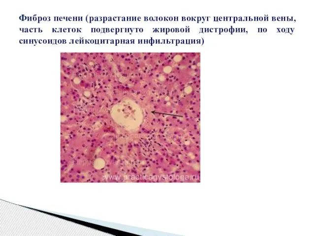 Фиброз печени (разрастание волокон вокруг центральной вены, часть клеток подвергнуто жировой дистрофии,