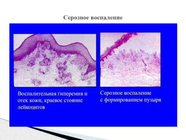 Серозное воспаление