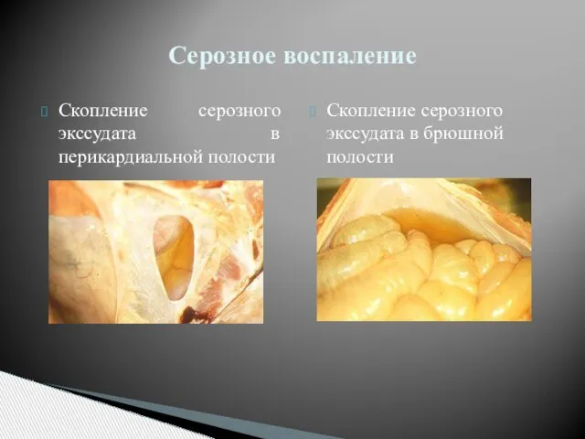 Скопление серозного экссудата в перикардиальной полости Скопление серозного экссудата в брюшной полости Серозное воспаление