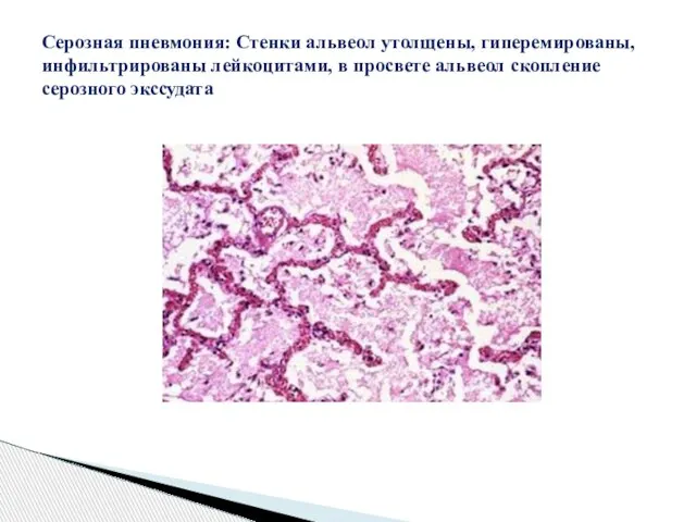 Серозная пневмония: Стенки альвеол утолщены, гиперемированы, инфильтрированы лейкоцитами, в просвете альвеол скопление серозного экссудата