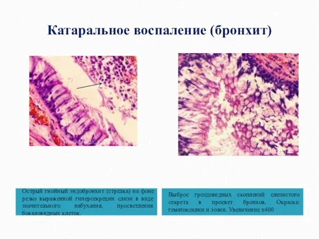 Катаральное воспаление (бронхит) Острый гнойный эндобронхит (стрелка) на фоне резко выраженной гиперсекреции