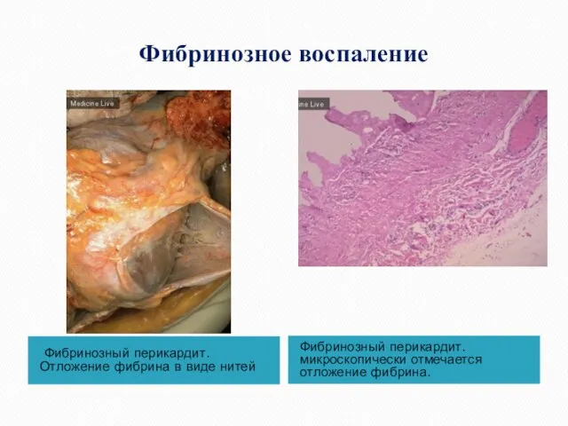Фибринозное воспаление Фибринозный перикардит. Отложение фибрина в виде нитей Фибринозный перикардит. микроскопически отмечается отложение фибрина.