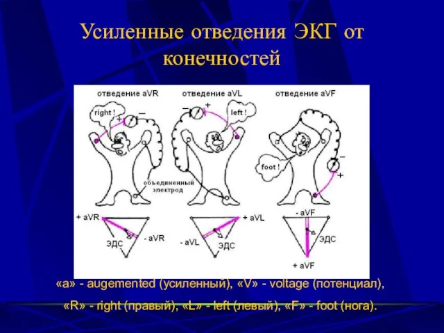 Усиленные отведения ЭКГ от конечностей «а» - augemented (усиленный), «V» - voltage