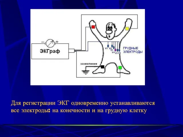 Для регистрации ЭКГ одновременно устанавливаются все электроды: на конечности и на грудную клетку