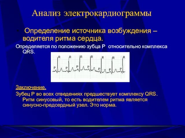 Анализ электрокардиограммы Определение источника возбуждения – водителя ритма сердца. Определяется по положению