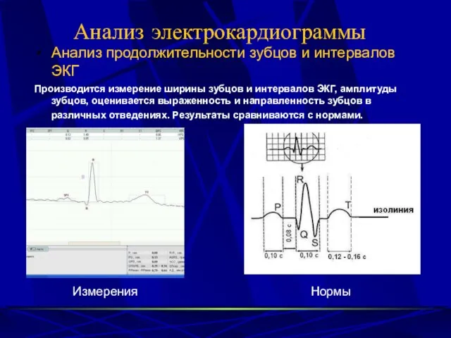 Анализ электрокардиограммы Анализ продолжительности зубцов и интервалов ЭКГ Производится измерение ширины зубцов