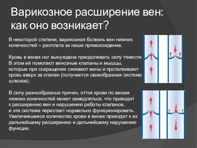 Варикозное расширение вен: как оно возникает? В некоторой степени, варикозная болезнь вен