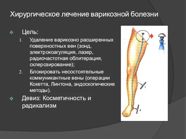 Хирургическое лечение варикозной болезни Цель: Удаление варикозно расширенных поверхностных вен (зонд, электрокоагуляция,