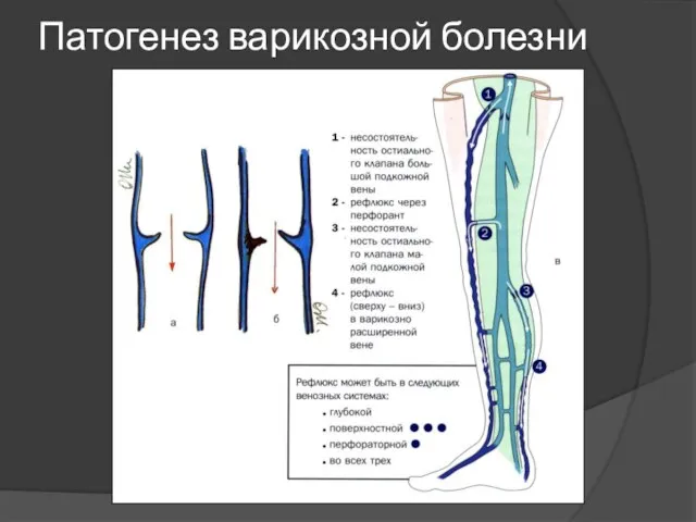 Патогенез варикозной болезни