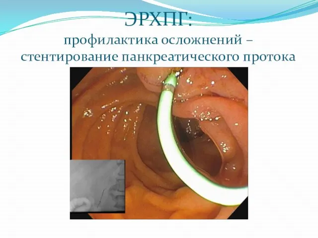 ЭРХПГ: профилактика осложнений – стентирование панкреатического протока