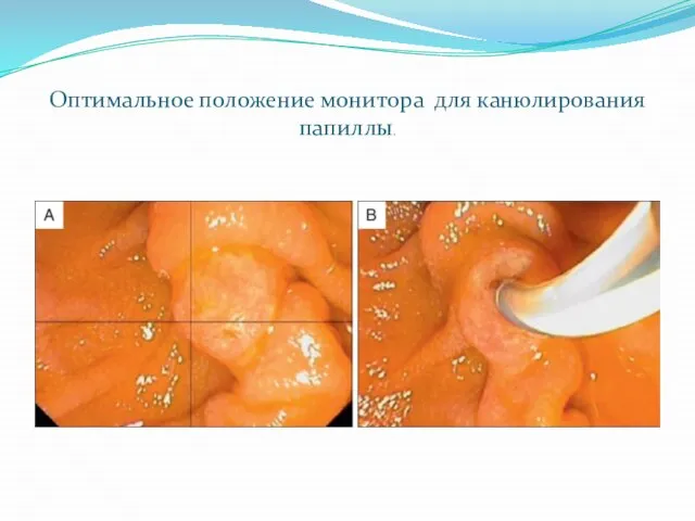 Оптимальное положение монитора для канюлирования папиллы.