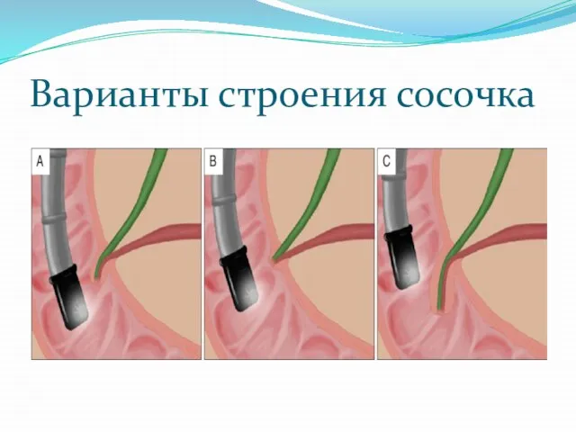 Варианты строения сосочка