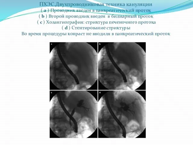 ПХЭС.Двухпроводниковая техника кануляции ( a ) Проводник введен в панкреатический проток (