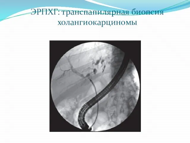 ЭРПХГ: транспапилярная биопсия холангиокарциномы