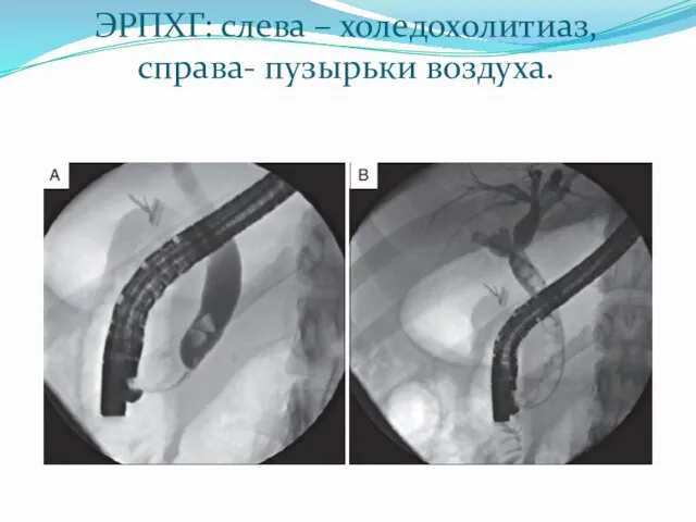 ЭРПХГ: слева – холедохолитиаз, справа- пузырьки воздуха.