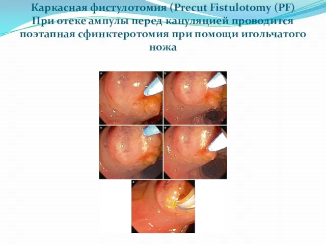 Каркасная фистулотомия (Precut Fistulotomy (PF) При отеке ампулы перед кануляцией проводится поэтапная