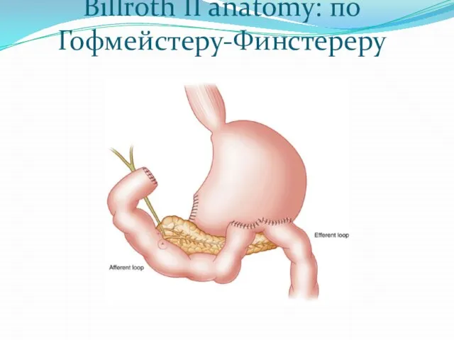 Billroth II anatomy: по Гофмейстеру-Финстереру