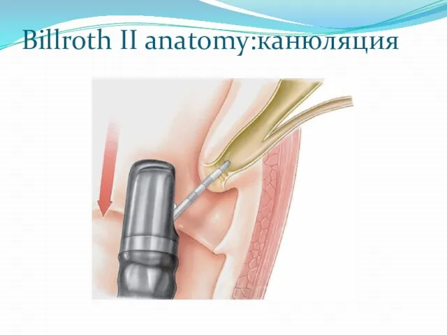 Billroth II anatomy:канюляция