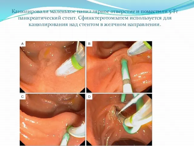 Канюлировали маленькое папиллярное отверстие и поместили 5-Fr панкреатический стент. Сфинктеротомзатем используется для