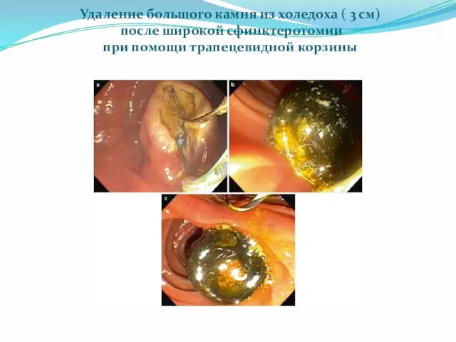 Удаление большого камня из холедоха ( 3 см) после широкой сфинктеротомии при помощи трапецевидной корзины