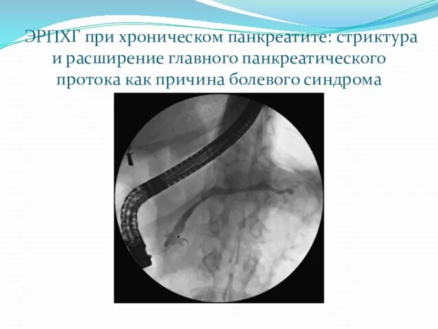 ЭРПХГ при хроническом панкреатите: стриктура и расширение главного панкреатического протока как причина болевого синдрома